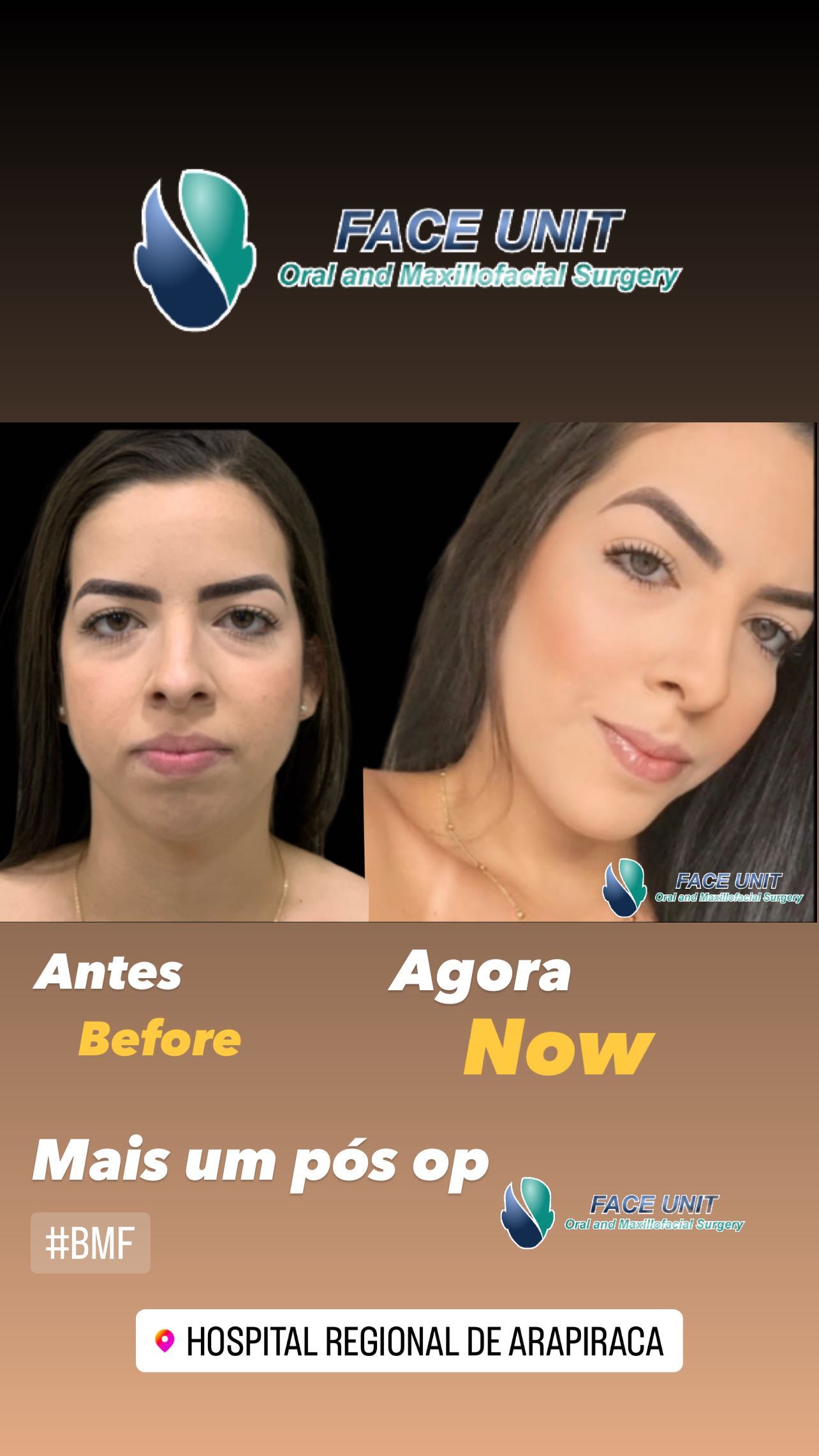 Mentoplastia Caso