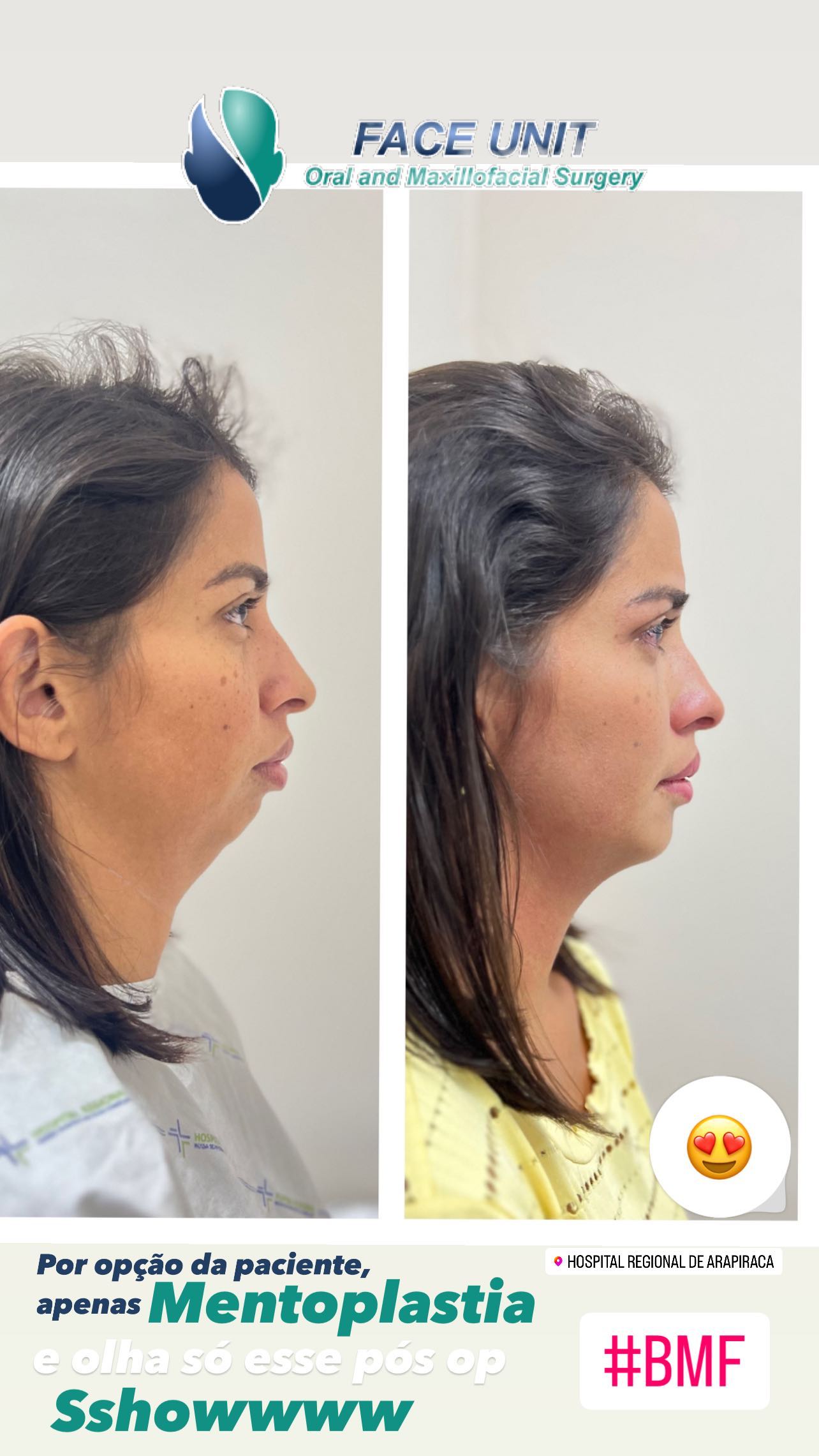 Mentoplastia Caso