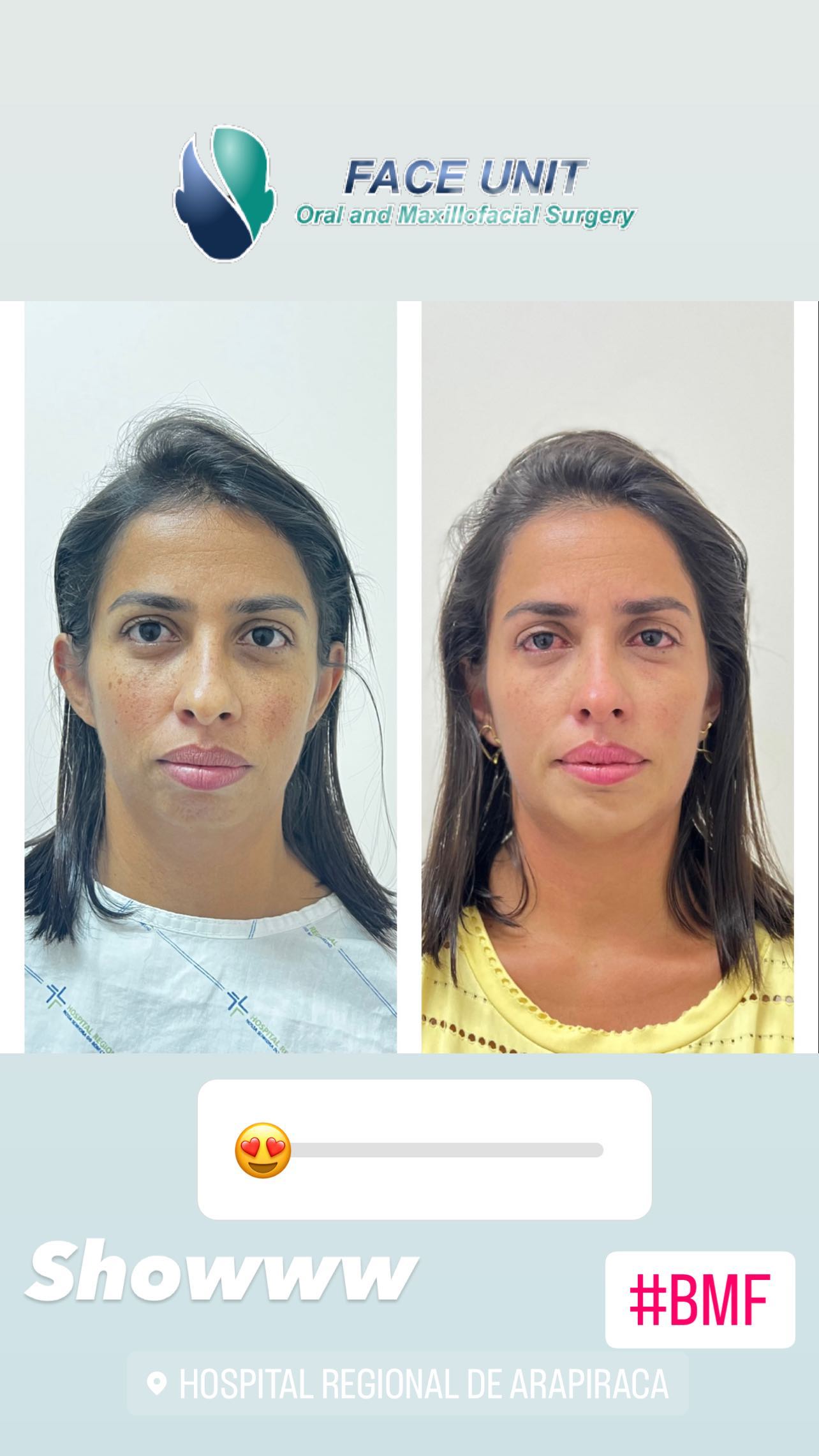 Mentoplastia Caso