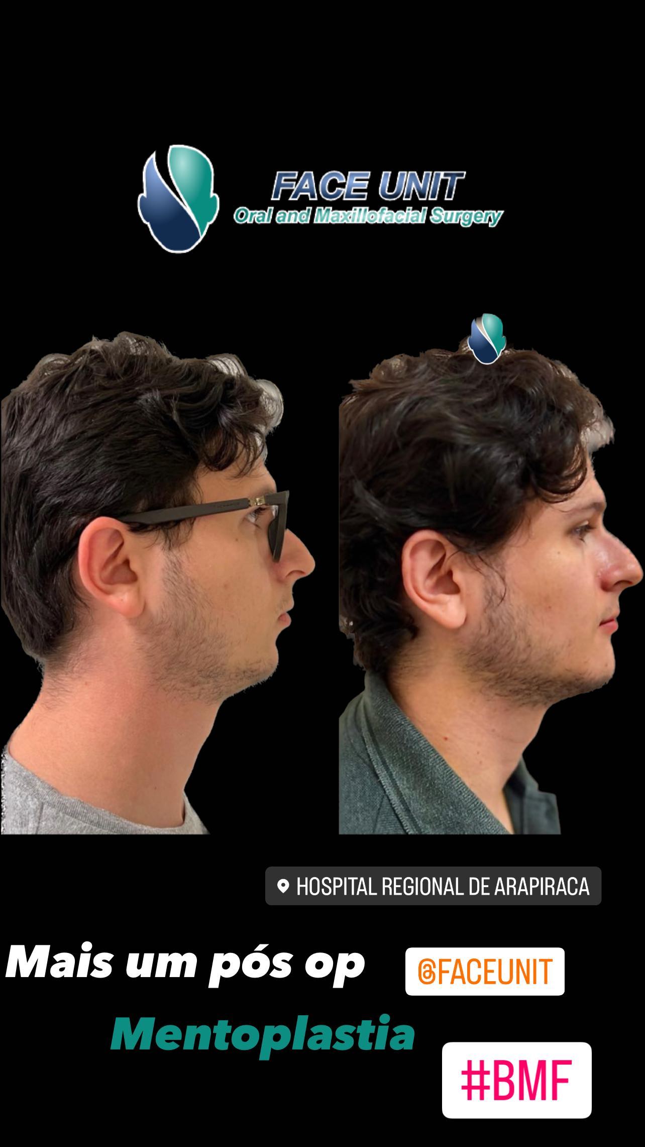 Mentoplastia Caso