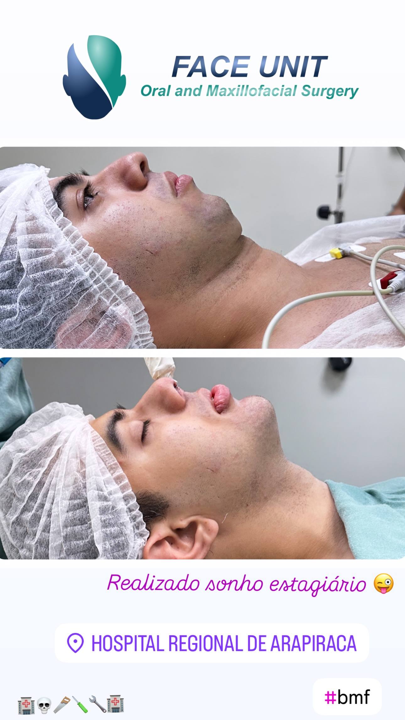 Mentoplastia Caso
