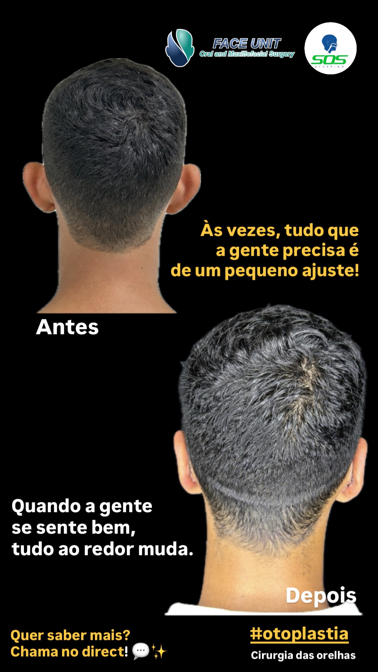 Otoplastia Caso