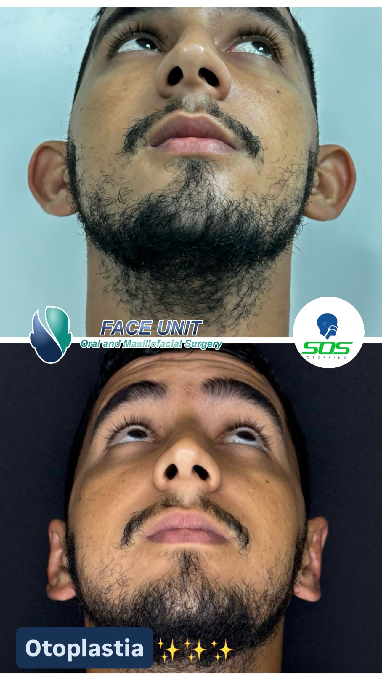 Otoplastia Caso